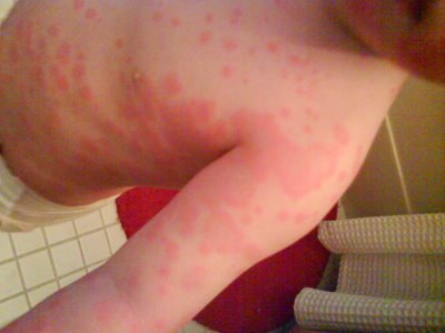 Symptoms Of Hives